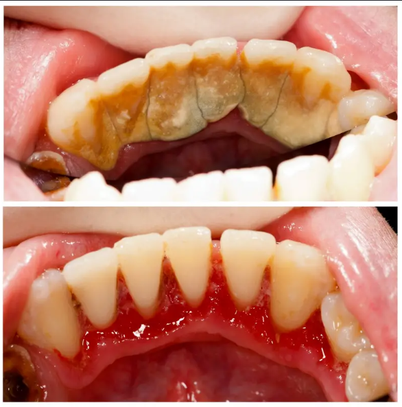 Dental treatment before and after result 5
